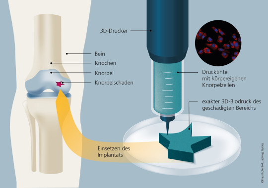 Schema von Knie und 3D-Druck